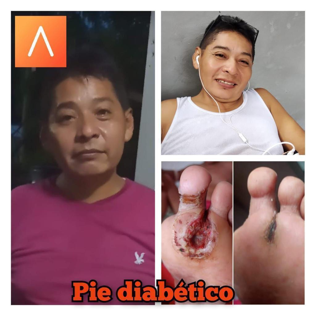 Antes: Pie diabético con lesión severa que no cicatrizaba